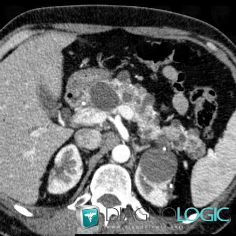 Von Hippel-Lindau syndrome, Pancreas, CT