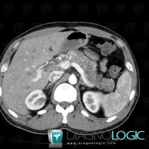 Von Hippel-Lindau syndrome, Pancreas, CT