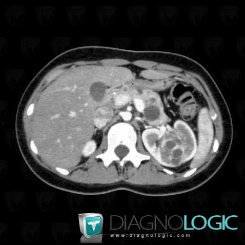 Von Hippel-Lindau syndrome, Pancreas, CT