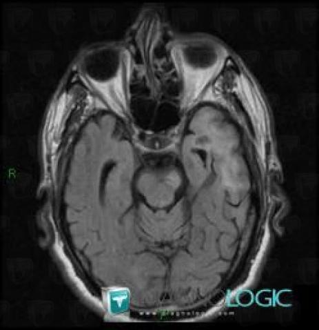 Wallerian degeneration, Brainstem, MRI