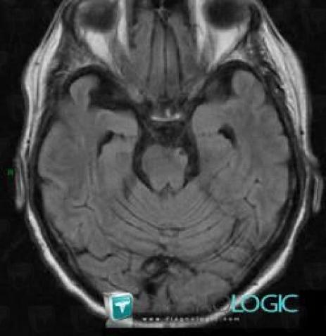 Wallerian degeneration, Brainstem, MRI