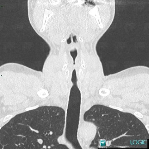 Wegener’s granulomatosis, Airways, CT