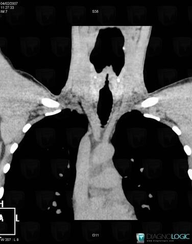 Wegener’s granulomatosis, Airways, CT