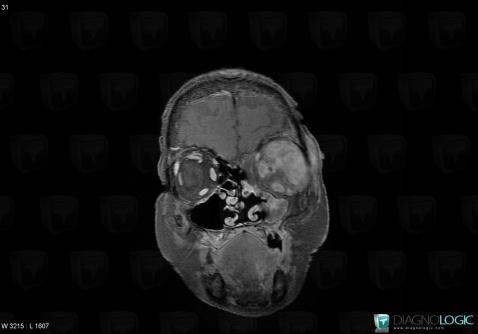 Wegener’s granulomatosis, Eye, MRI