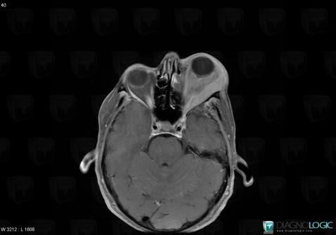 Wegener’s granulomatosis, Eye, MRI