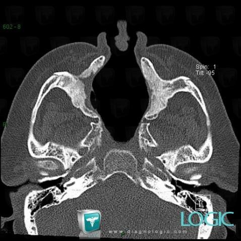 Wegener’s granulomatosis, Nasal cavity / Nasopharynx, CT