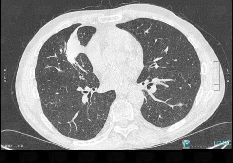 Wegener’s granulomatosis, Pulmonary parenchyma, CT