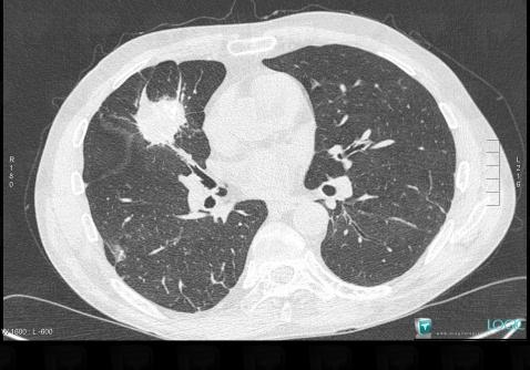 Wegener’s granulomatosis, Pulmonary parenchyma, CT