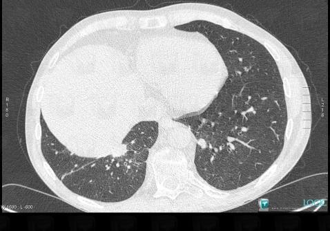 Wegener’s granulomatosis, Pulmonary parenchyma, CT