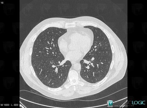 Wegener’s granulomatosis, Pulmonary parenchyma, CT