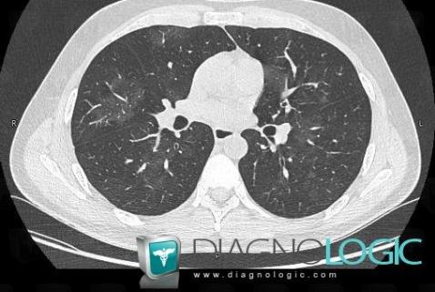 Wegener’s granulomatosis, Pulmonary parenchyma, CT