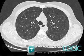 Wegener’s granulomatosis, Pulmonary parenchyma, CT