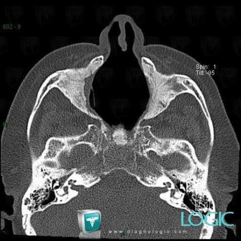 Wegener’s granulomatosis, Sinus, CT