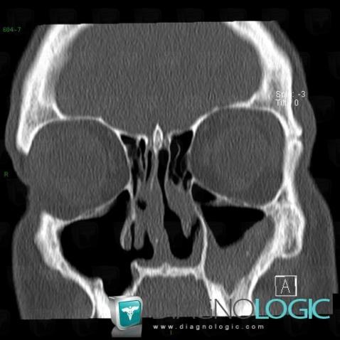 Wegener’s granulomatosis, Sinus, CT