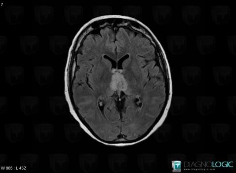 Wernicke encephalopathy, Basal ganglia and capsule, Ventricles / Periventricular region, MRI