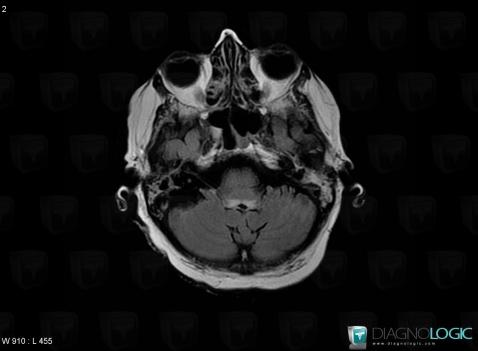 Wernicke encephalopathy, Brainstem, V4 and vermis, MRI