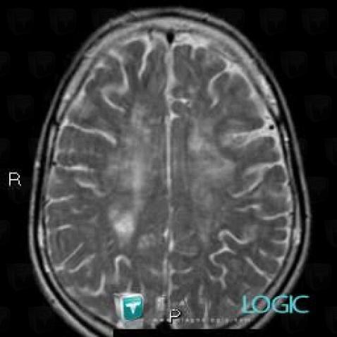 Whipple’s disease, Cerebral hemispheres, MRI