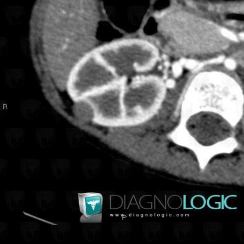 Wilm’s tumor, Kidney, CT