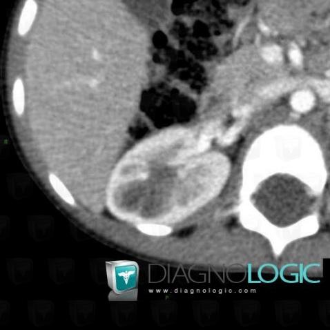 Wilm’s tumor, Kidney, CT