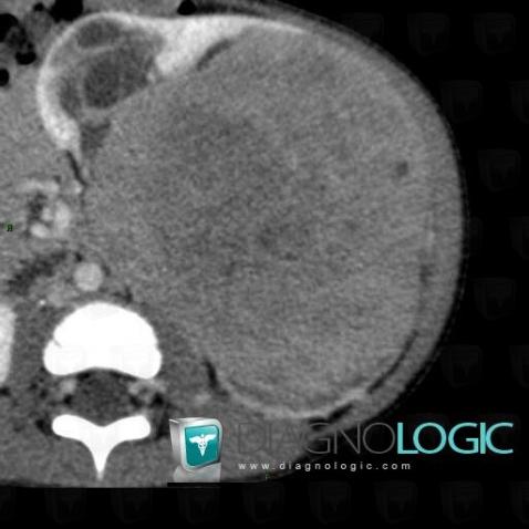 Wilm’s tumor, Kidney, CT