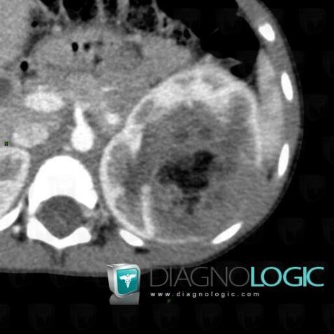 Wilm’s tumor, Kidney, CT