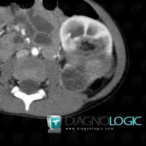 Wilm’s tumor, Kidney, CT