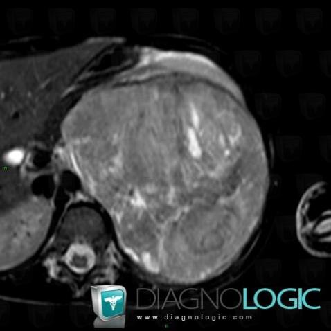 Wilm’s tumor, Kidney, Retroperitoneum, MRI