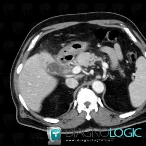 Xanthogranulomatous cholecystitis, Gallbladder, CT